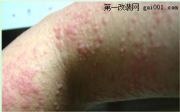 北京哪家医院皮肤科专家在线咨询,湿疹的症状及图片